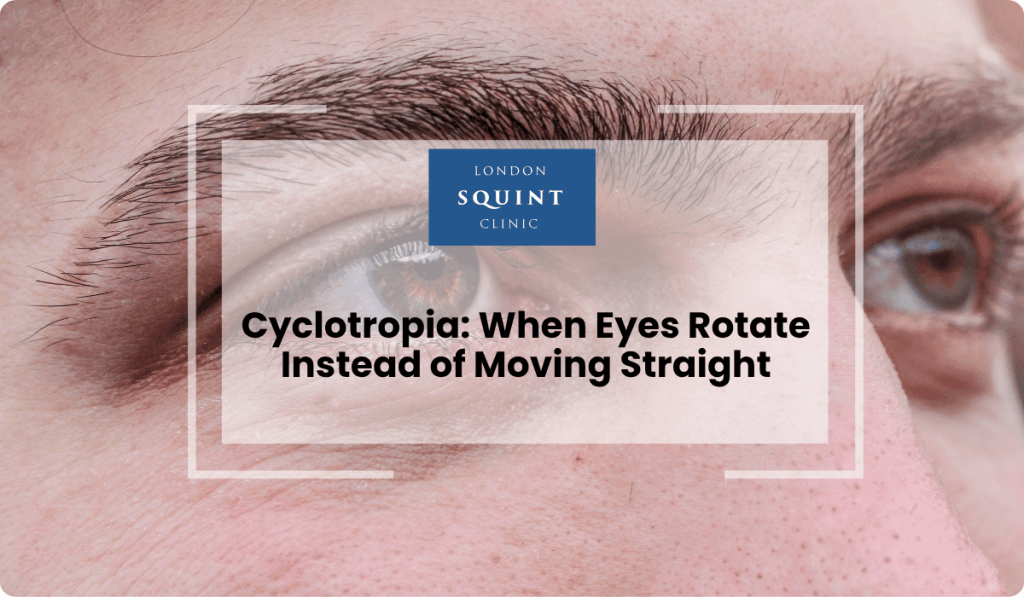 cyclotropia eyes rotate instead moving straight