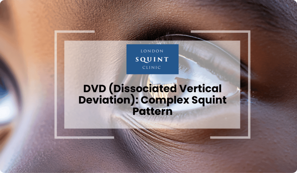 dvd dissociated vertical deviation complex squint
