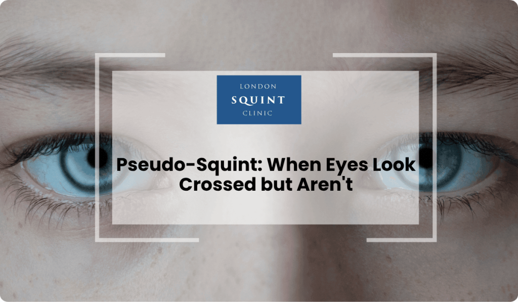 pseudo squint eyes look crossed but arent