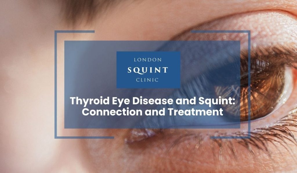 Thyroid Eye Disease and Squint